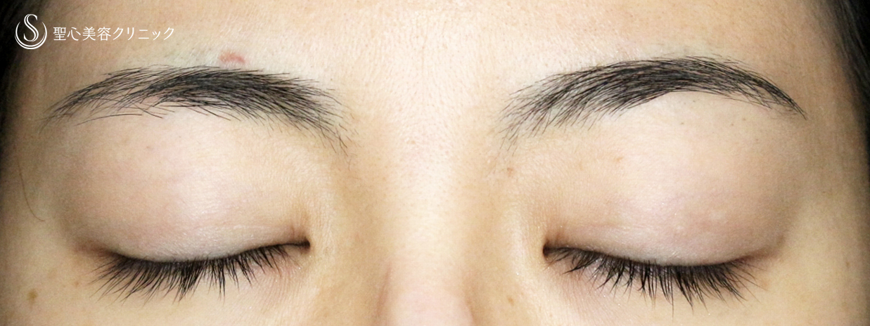 【20代女性・美容外科で行う眼瞼下垂の治療】切らない眼瞼下垂+α法（3年8ヶ月後） After 