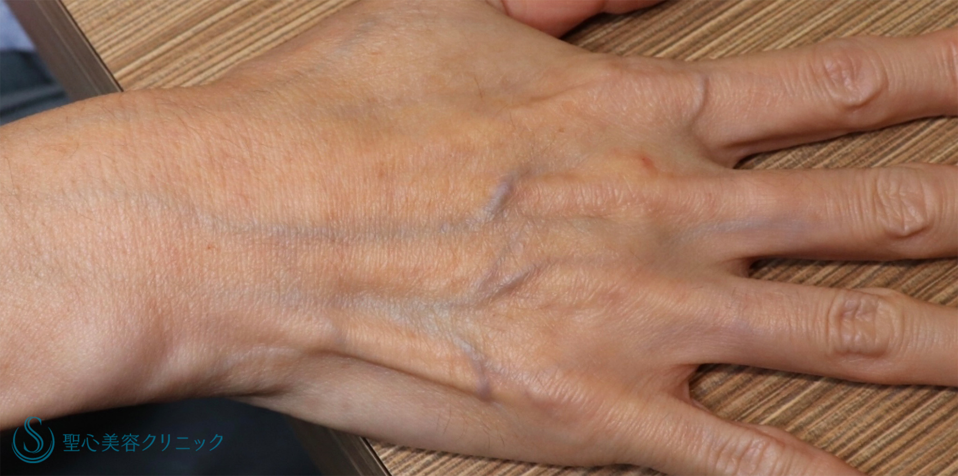【50代女性・手の甲の若返り】プレミアムPRP皮膚再生療法（2年後） Before 