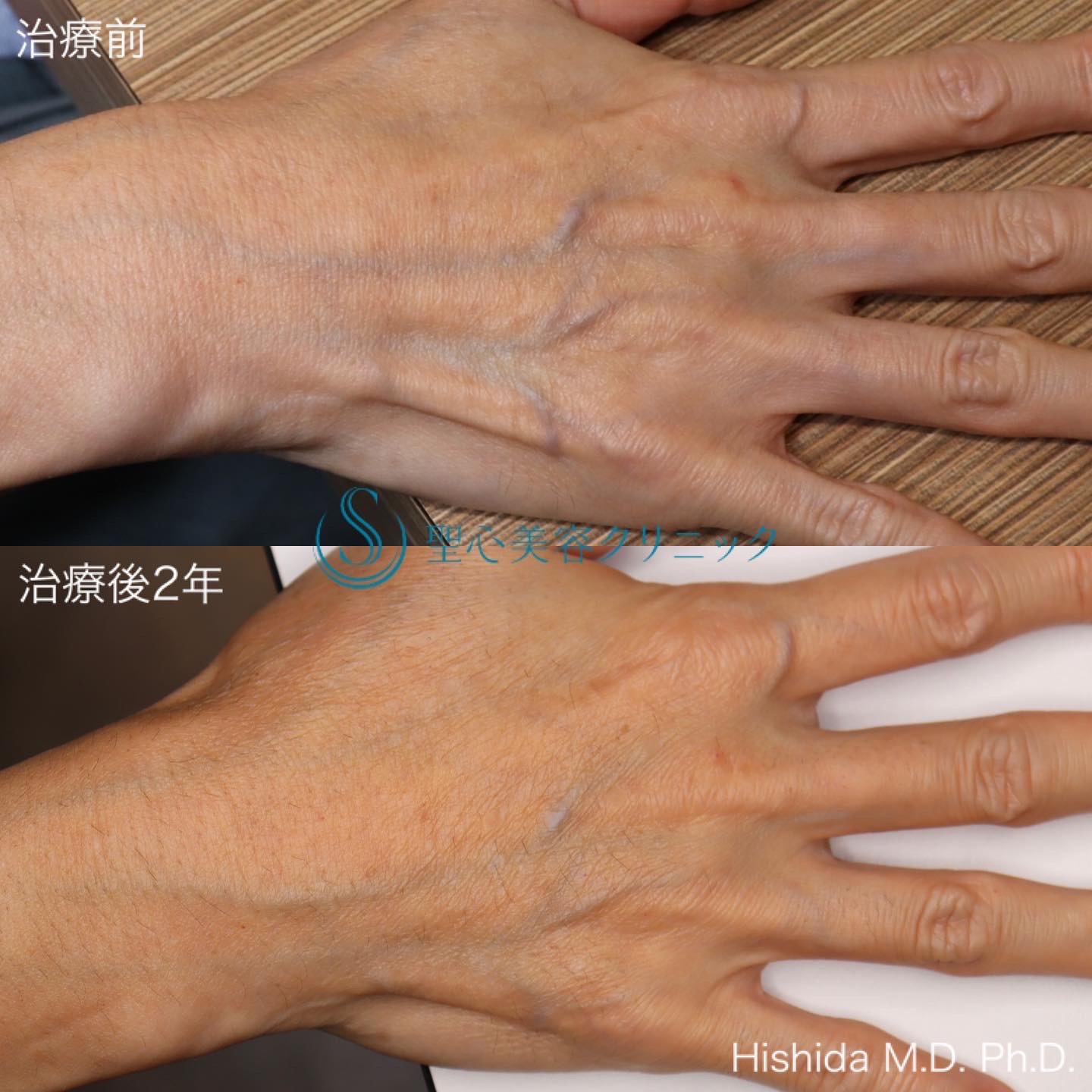 【50代女性・手の甲の若返り】プレミアムPRP皮膚再生療法（2年後） After 