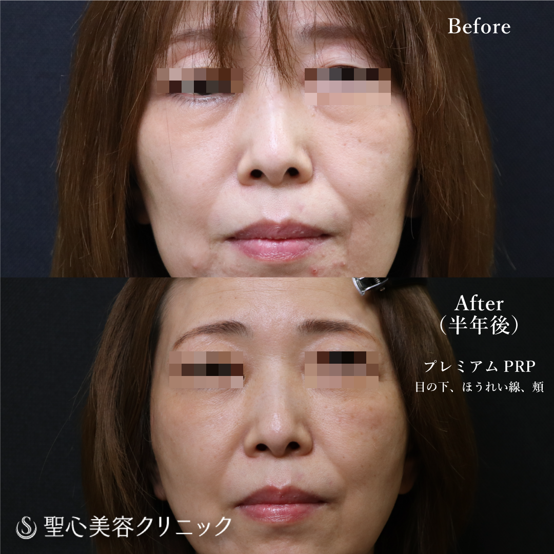 【50代女性・目の下・ほうれい線・頬】 プレミアムPRP皮膚再生療法（1ヶ月後、半年後、1年後） Before 