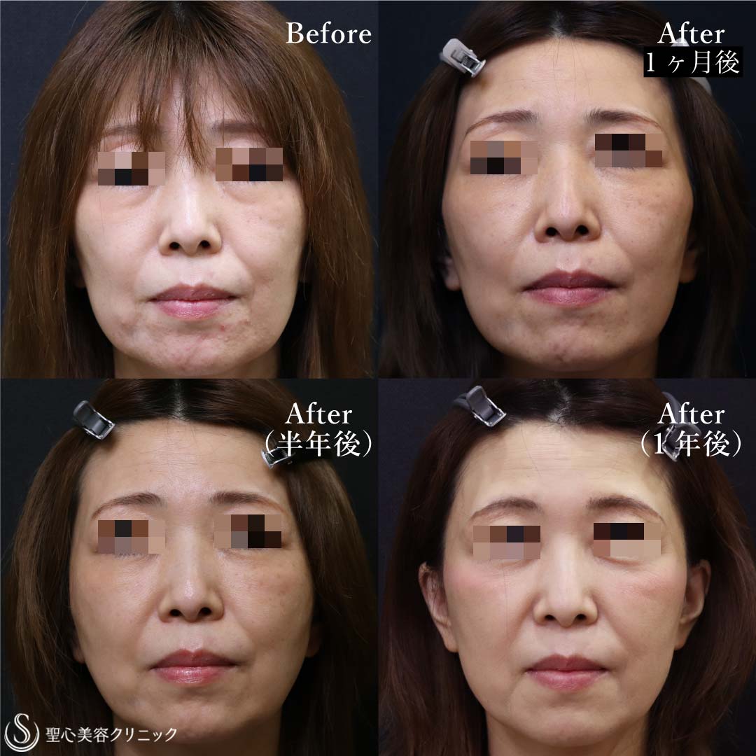 【50代女性・目の下・ほうれい線・頬】 プレミアムPRP皮膚再生療法（1ヶ月後、半年後、1年後） After 