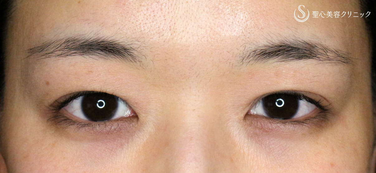 【20代女性・微調整や修正も腫れが少ない】マイクロメソッド+α （直後〜3年後→左修正の経過） Before 