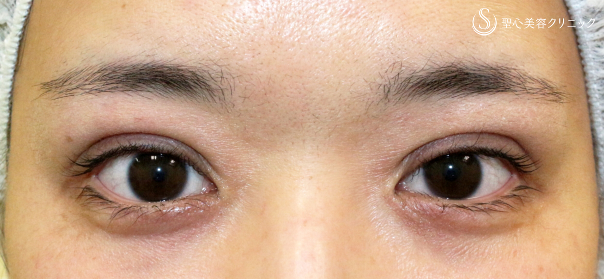 【20代女性・微調整や修正も腫れが少ない】マイクロメソッド+α （直後〜3年後→左修正の経過） Before 