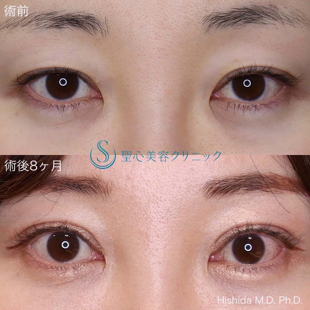 【30代女性・目を大きくパッチリに！！そして平行型に！！】眼瞼下垂（切開法/腱膜縫縮法）+目上切開（8ヶ月後） After 