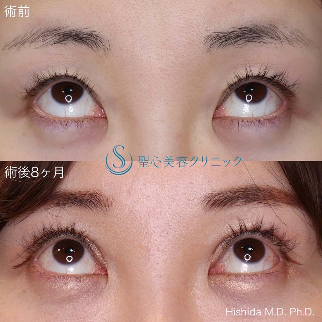 【30代女性・目を大きくパッチリに！！そして平行型に！！】眼瞼下垂（切開法/腱膜縫縮法）+目上切開（8ヶ月後） After 