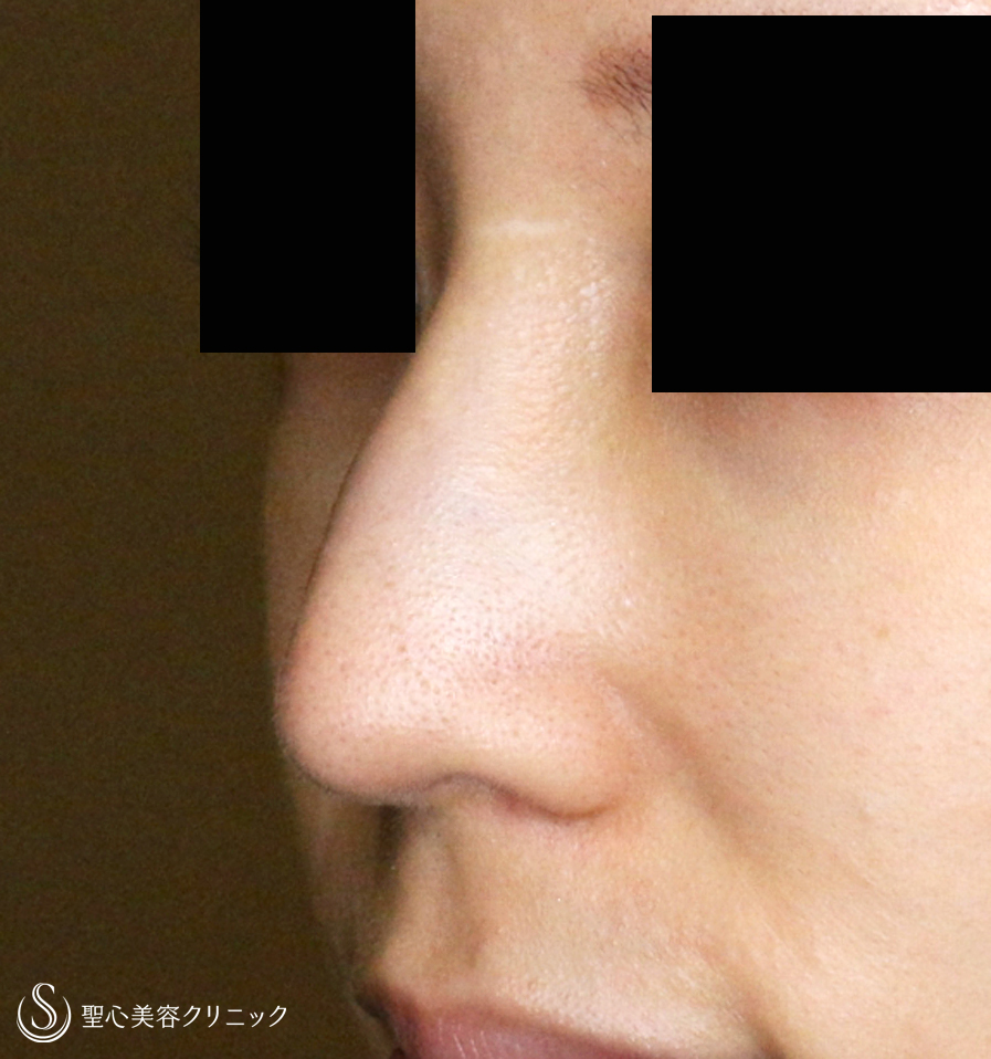【20代女性・満足度が高い鼻のプチ整形】Gメッシュ単独（処置直後〜6年7ヶ月後） After 