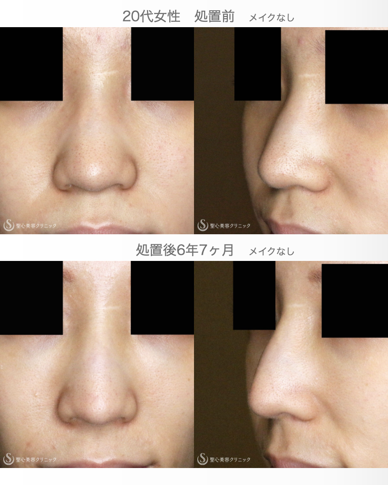 【20代女性・満足度が高い鼻のプチ整形】Gメッシュ単独（処置直後〜6年7ヶ月後） After 