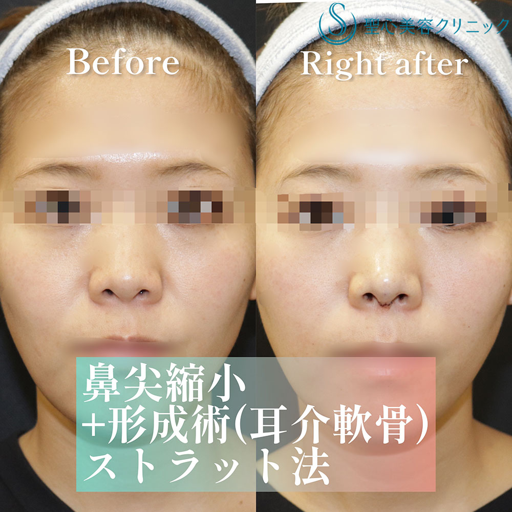 【20代女性・鼻先を高く細く、ナチュラルに】 鼻尖縮小＋ 鼻尖形成（耳介軟骨移植）＋ ストラット法（鼻柱補強術）（直後） Before 