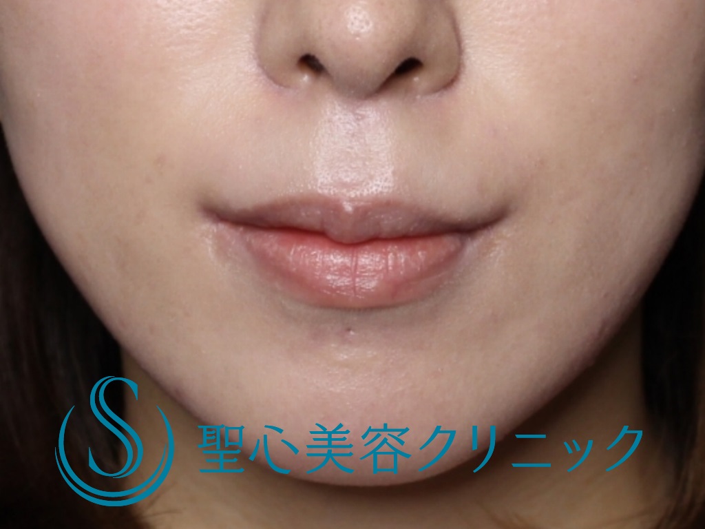 口角 ぴくつき: 顔面 ぴくつき 対処法 – OTZF