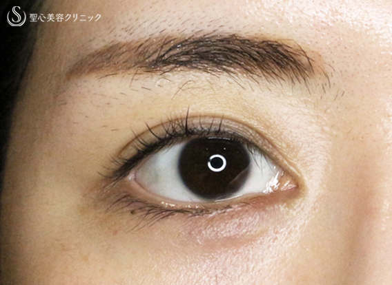 【20代女性・理想的なアーモンドアイ】目頭切開+α法 単独（術後5年の長期経過） After 