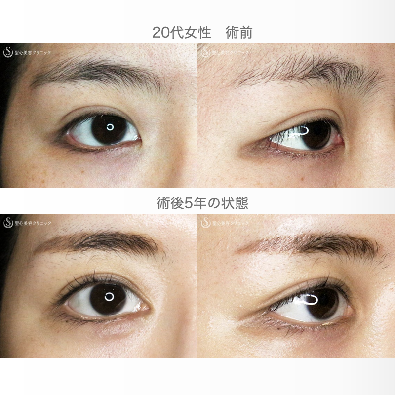 【20代女性・理想的なアーモンドアイ】目頭切開+α法 単独（術後5年の長期経過） After 