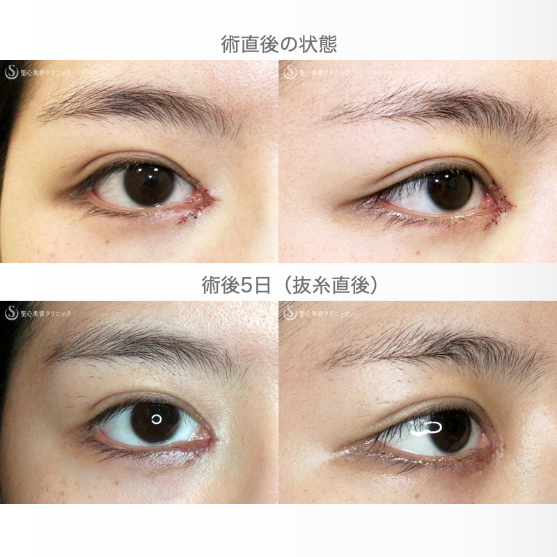 【20代女性・理想的なアーモンドアイ】目頭切開+α法 単独（術後5年の長期経過） Before 