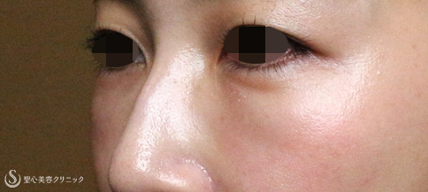 【40代女性・目の下ヒアルロン酸を溶かす】経結膜下脱脂術→プレミアムPRP皮膚再生療法（3年後） Before 