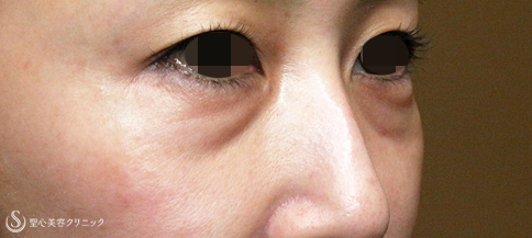 【40代女性・目の下ヒアルロン酸を溶かす】経結膜下脱脂術→プレミアムPRP皮膚再生療法（3年後） Before 