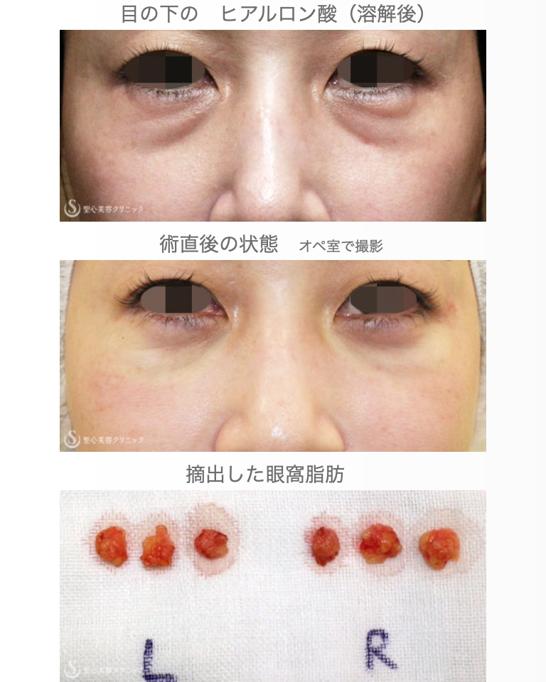 【40代女性・目の下ヒアルロン酸を溶かす】経結膜下脱脂術→プレミアムPRP皮膚再生療法（3年後） After 