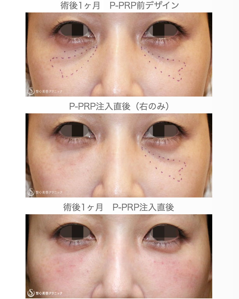 【40代女性・目の下ヒアルロン酸を溶かす】経結膜下脱脂術→プレミアムPRP皮膚再生療法（3年後） After 