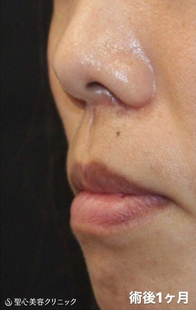 【20代女性・鼻の下を短くしたい！】リップリフト（人中短縮術）（1か月後） After 