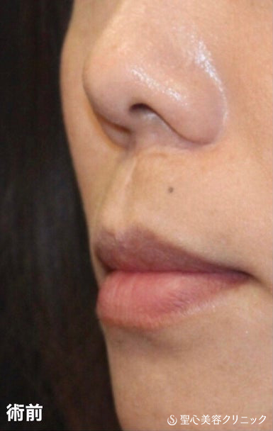 【20代女性・鼻の下を短くしたい！】リップリフト（人中短縮術）（1か月後） Before 