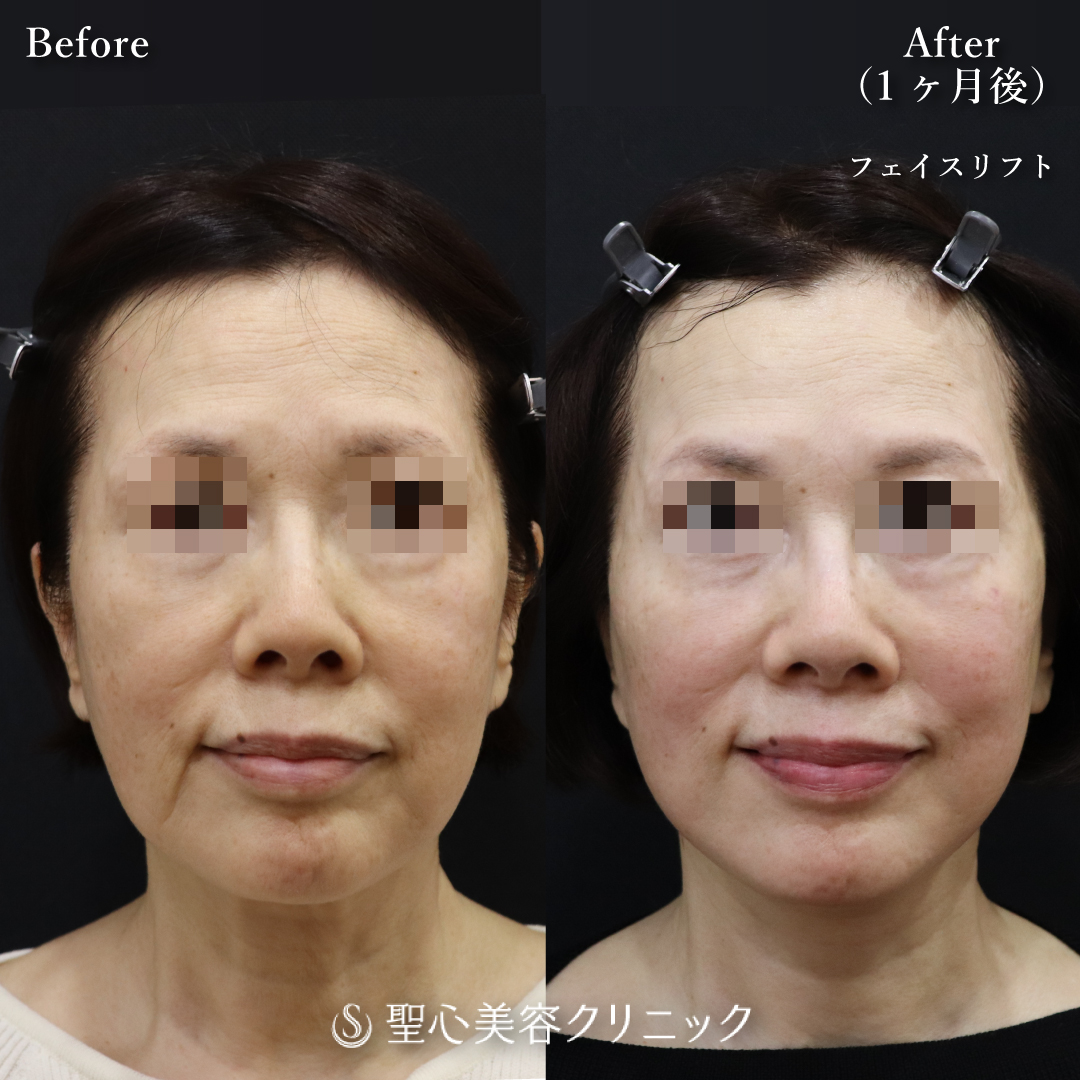 【60代女性・2回目のフェイスリフト】フェイスリフト（1ヶ月後） Before 