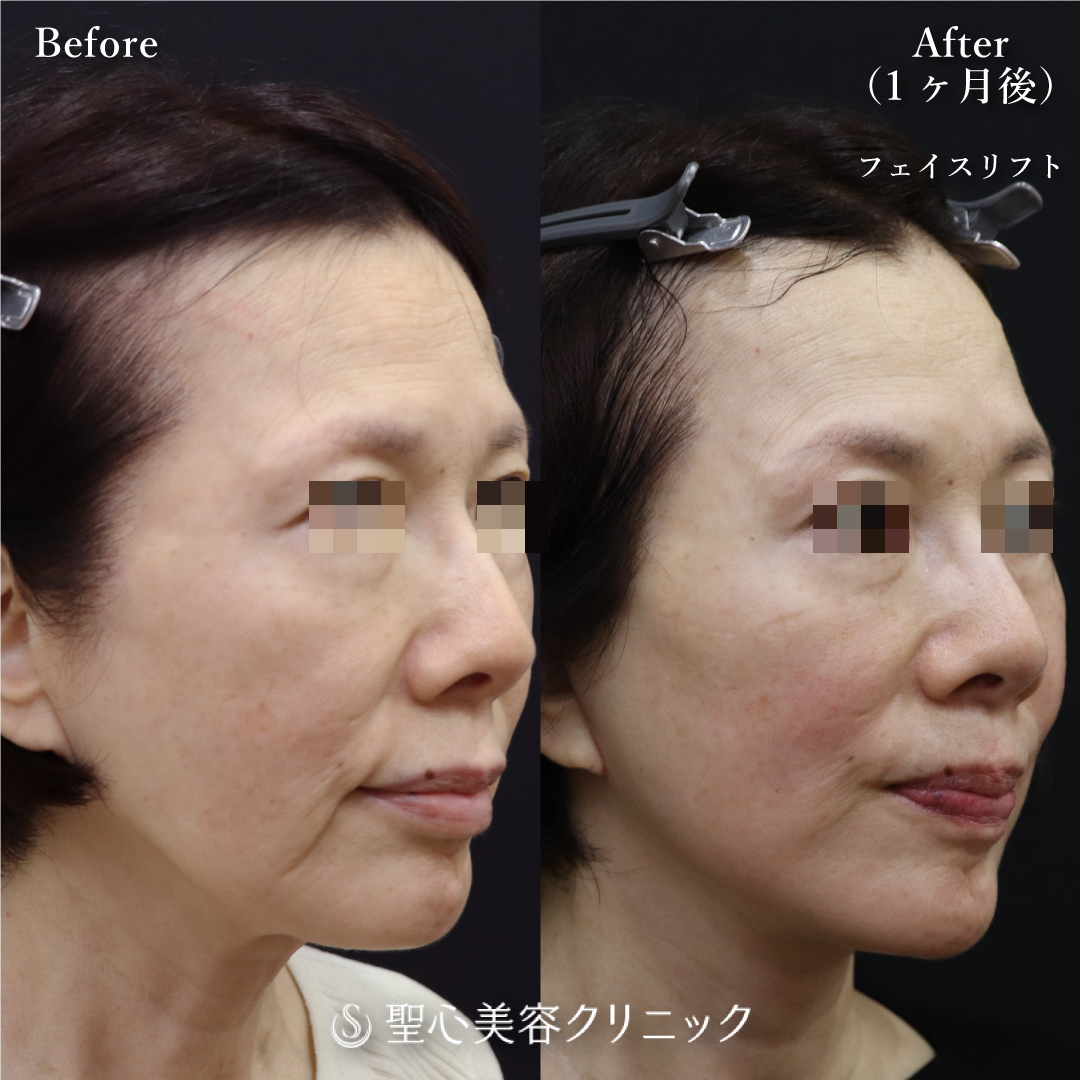 【60代女性・2回目のフェイスリフト】フェイスリフト（1ヶ月後） After 