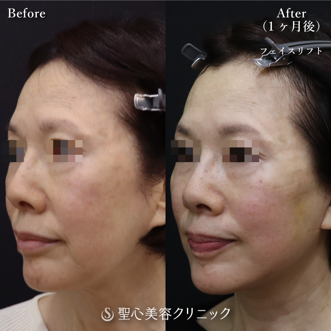 【60代女性・2回目のフェイスリフト】フェイスリフト（1ヶ月後） After 