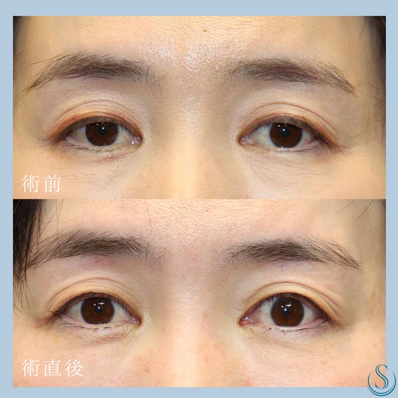 【40代女性・糸で下垂を修正】 眼瞼下垂（埋没法）（直後） Before 