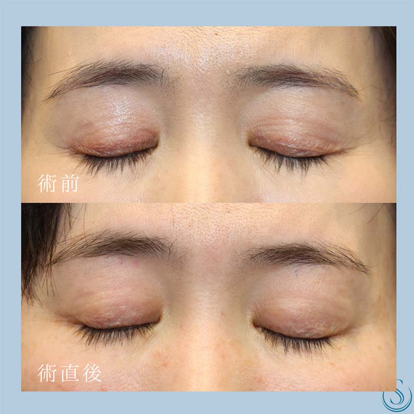【40代女性・糸で下垂を修正】 眼瞼下垂（埋没法）（直後） After 