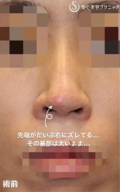 【40代女性・他院修正手術】オステオポール・メッシュ抜去 + 鼻先再建（手術直後） Before 