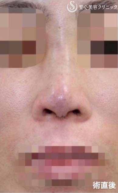 【40代女性・他院修正手術】オステオポール・メッシュ抜去 + 鼻先再建（手術直後） After 