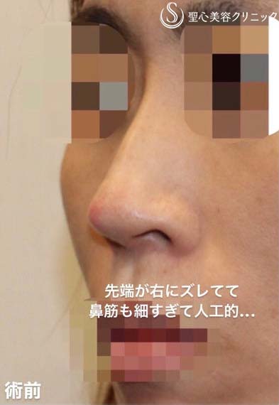 【40代女性・他院修正手術】オステオポール・メッシュ抜去 + 鼻先再建（手術直後） Before 