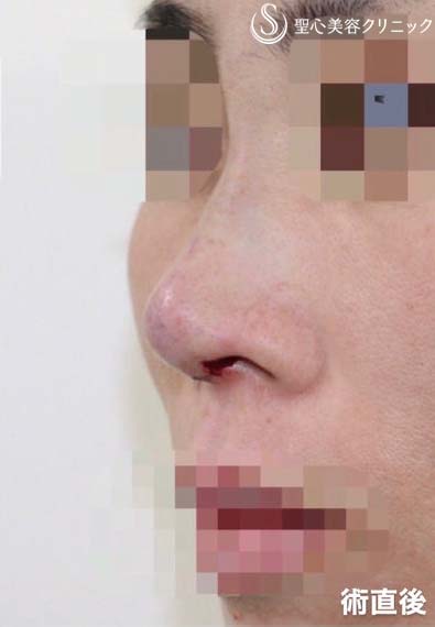 【40代女性・他院修正手術】オステオポール・メッシュ抜去 + 鼻先再建（手術直後） After 