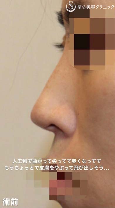 【40代女性・他院修正手術】オステオポール・メッシュ抜去 + 鼻先再建（手術直後） Before 