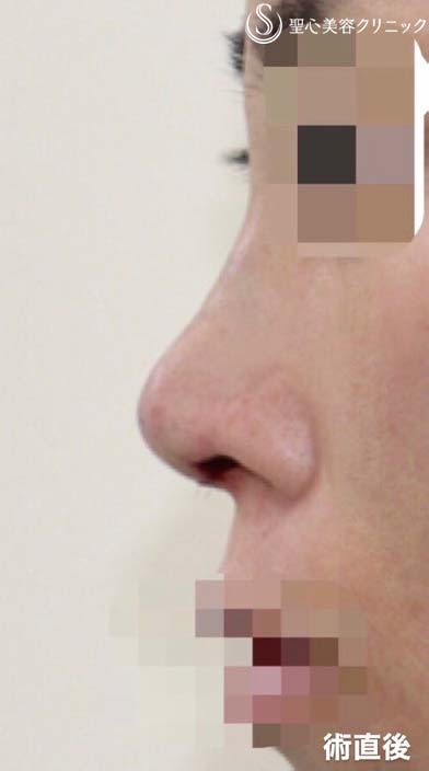 【40代女性・他院修正手術】オステオポール・メッシュ抜去 + 鼻先再建（手術直後） After 
