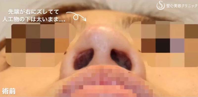 【40代女性・他院修正手術】オステオポール・メッシュ抜去 + 鼻先再建（手術直後） Before 