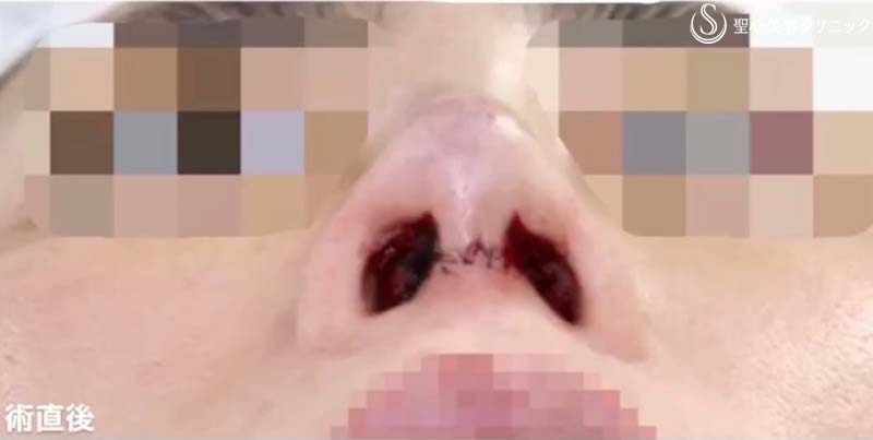 【40代女性・他院修正手術】オステオポール・メッシュ抜去 + 鼻先再建（手術直後） After 