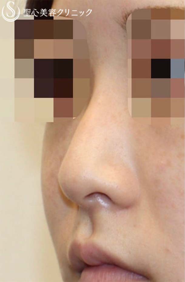 小鼻縮小+鼻尖縮小＋鼻尖形成（耳介軟骨移植）（術後1週間） Before