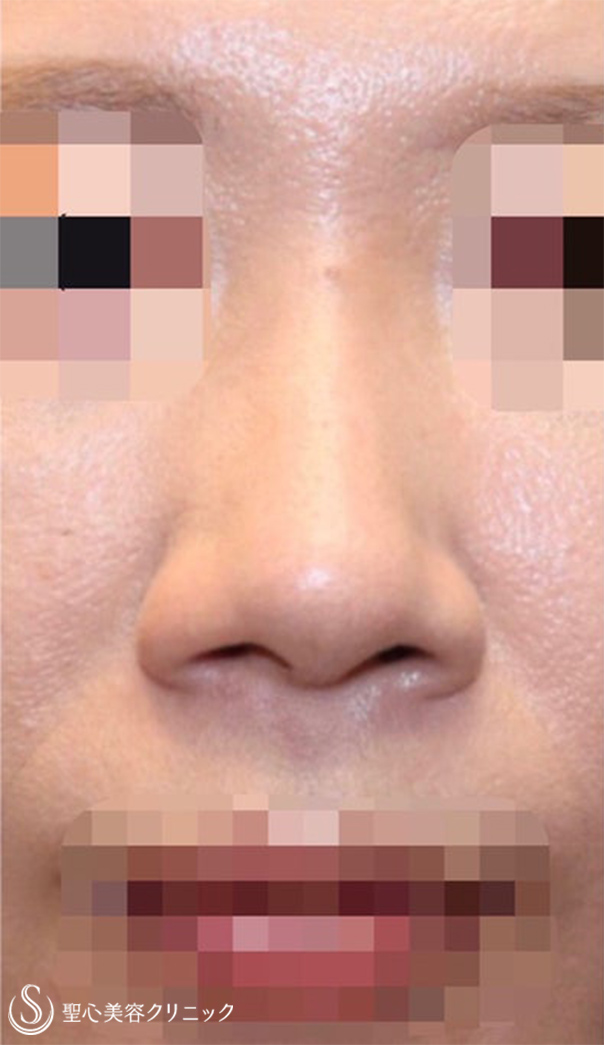 【30代女性・お鼻をスッキリ】鼻尖縮小+鼻尖形成(耳介軟骨移植)+鼻根プロテーゼ+小鼻縮小(術後1.5ヶ月) - 症例写真 - 美容整形、美容 ...