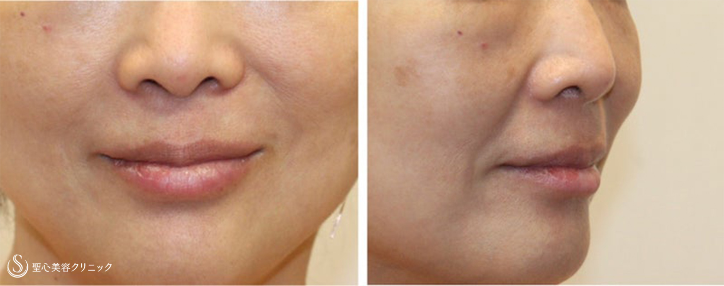 【50代女性・ほうれい線をスッキリ】プレミアムPRP皮膚再生療法（術後6ヶ月） Before 