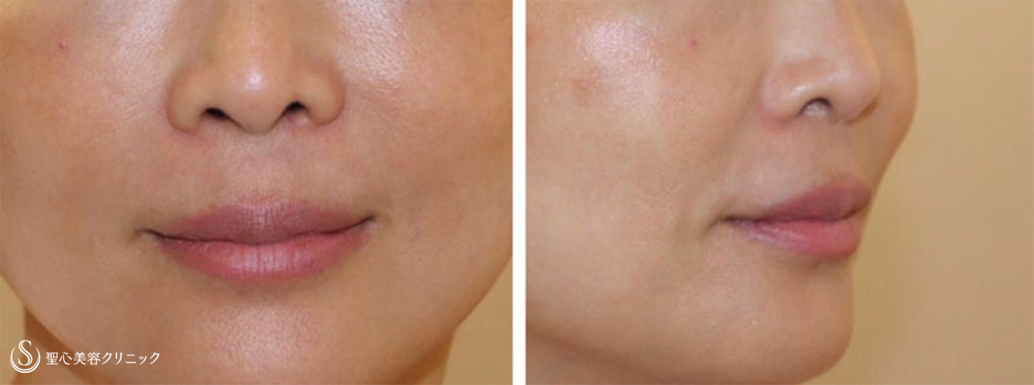 【50代女性・ほうれい線をスッキリ】プレミアムPRP皮膚再生療法（術後6ヶ月） After 
