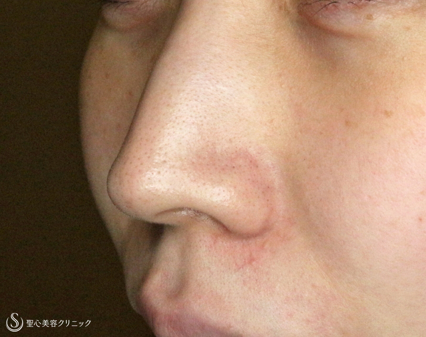 【20代女性・スマートな小鼻で「忘れ鼻」】小鼻縮小術+α法「Ver.5」（術直後〜3ヶ月後） Before 