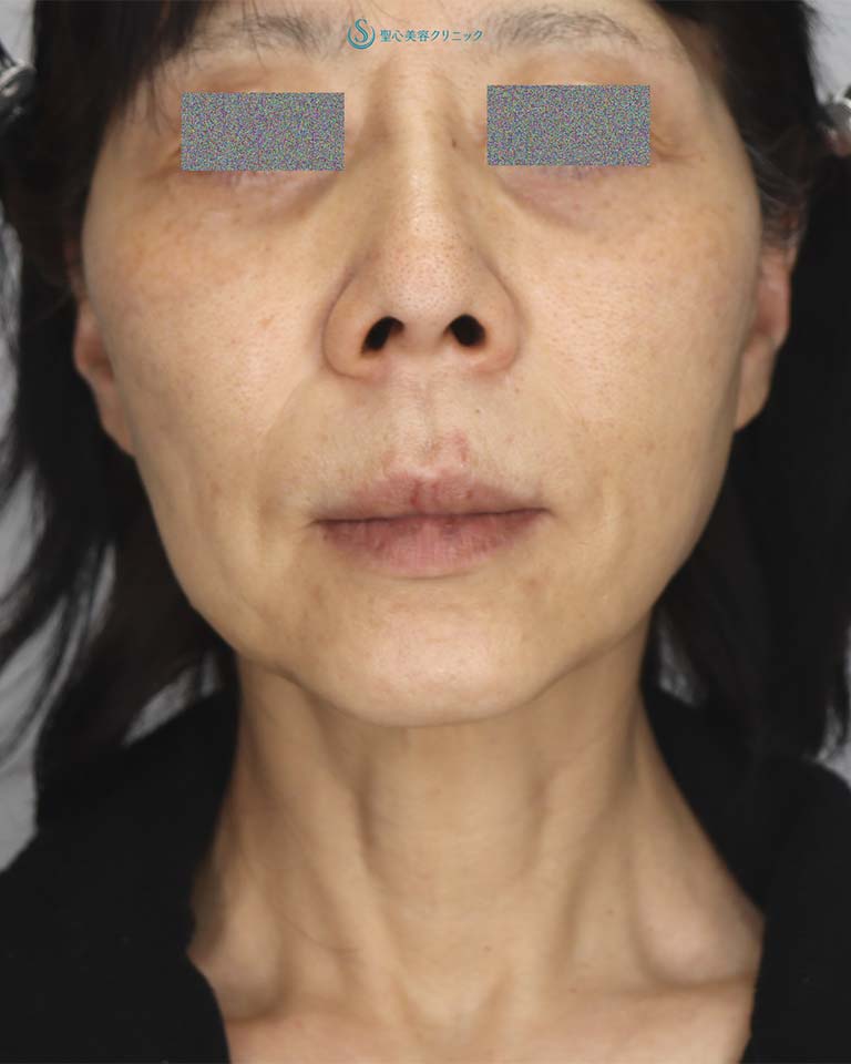 【50代女性・頬～首のたるみの改善、鼻下の長さの改善】フェイスリフト＋鼻下短縮術（人中短縮・リップリフト）（1ヶ月後） Before 