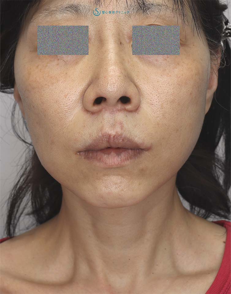 【50代女性・頬～首のたるみの改善、鼻下の長さの改善】フェイスリフト＋鼻下短縮術（人中短縮・リップリフト）（1ヶ月後） After 
