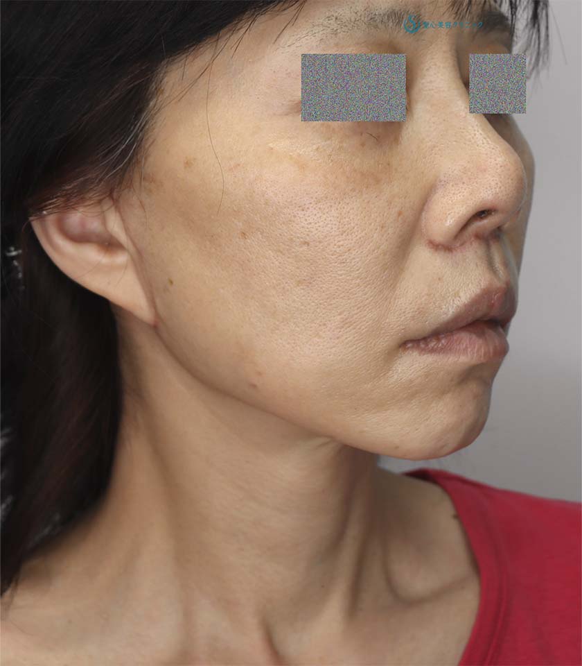 【50代女性・頬～首のたるみの改善、鼻下の長さの改善】フェイスリフト＋鼻下短縮術（人中短縮・リップリフト）（1ヶ月後） After 
