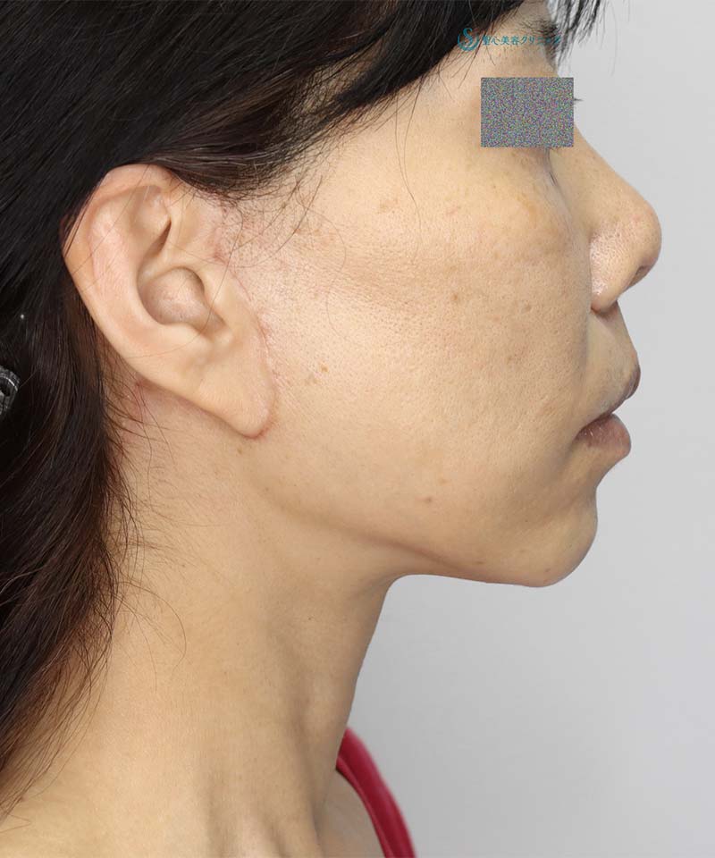 【50代女性・頬～首のたるみの改善、鼻下の長さの改善】フェイスリフト＋鼻下短縮術（人中短縮・リップリフト）（1ヶ月後） After 