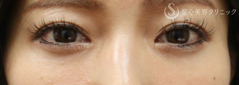 【30代女性・目の下の膨らみをスッキリ】経結膜下脱脂術（術後9ヶ月） After 