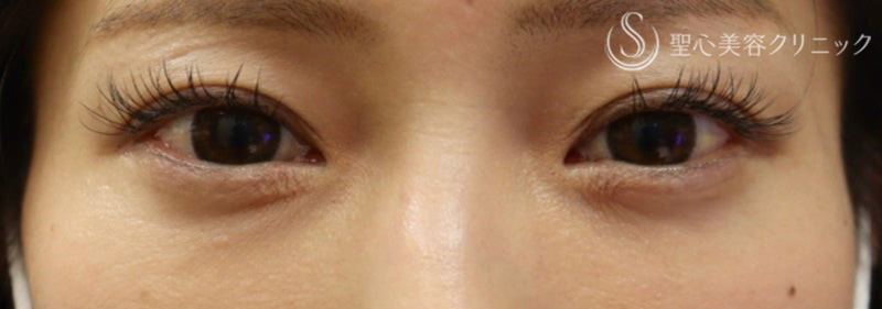 【30代女性・目の下の膨らみをスッキリ】経結膜下脱脂術（術後9ヶ月） Before 