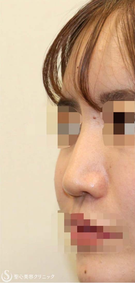 【20代女性・他院修正手術 美人鼻に】鼻中隔延長術(肋軟骨) + 鼻尖形成術(耳介軟骨)  + 鼻骨骨切り幅寄せ + プロテーゼ入替 (術後2週間) Before 