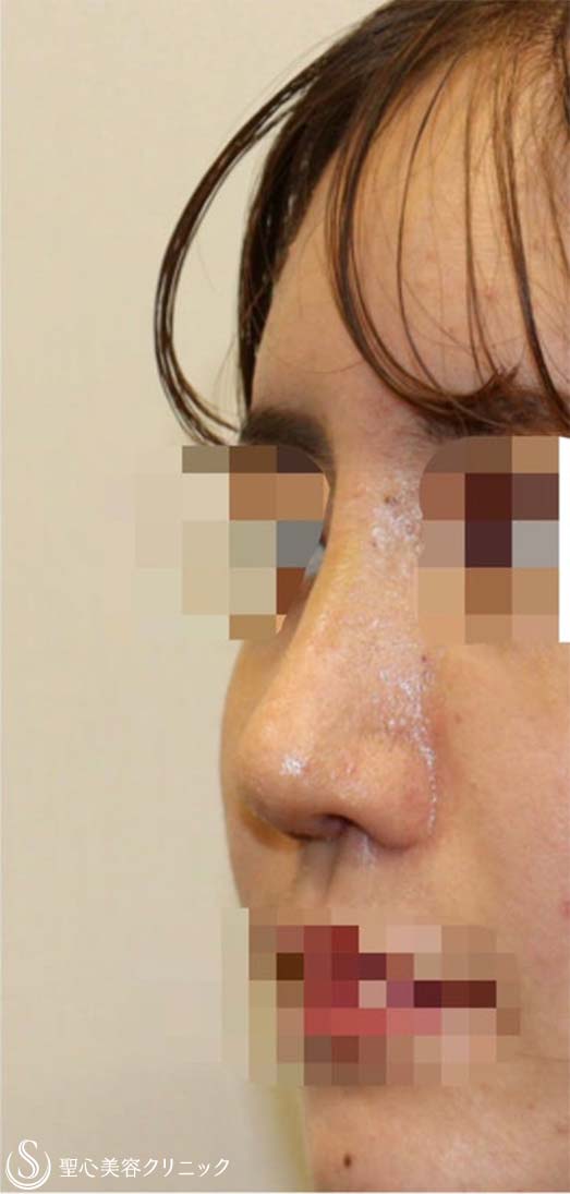 【20代女性・他院修正手術 美人鼻に】鼻中隔延長術(肋軟骨) + 鼻尖形成術(耳介軟骨)  + 鼻骨骨切り幅寄せ + プロテーゼ入替 (術後2週間) After 