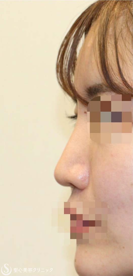 【20代女性・他院修正手術 美人鼻に】鼻中隔延長術(肋軟骨) + 鼻尖形成術(耳介軟骨)  + 鼻骨骨切り幅寄せ + プロテーゼ入替 (術後2週間) Before 