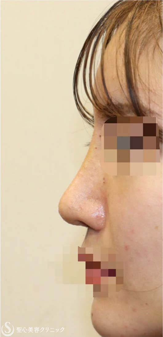 【20代女性・他院修正手術 美人鼻に】鼻中隔延長術(肋軟骨) + 鼻尖形成術(耳介軟骨)  + 鼻骨骨切り幅寄せ + プロテーゼ入替 (術後2週間) After 